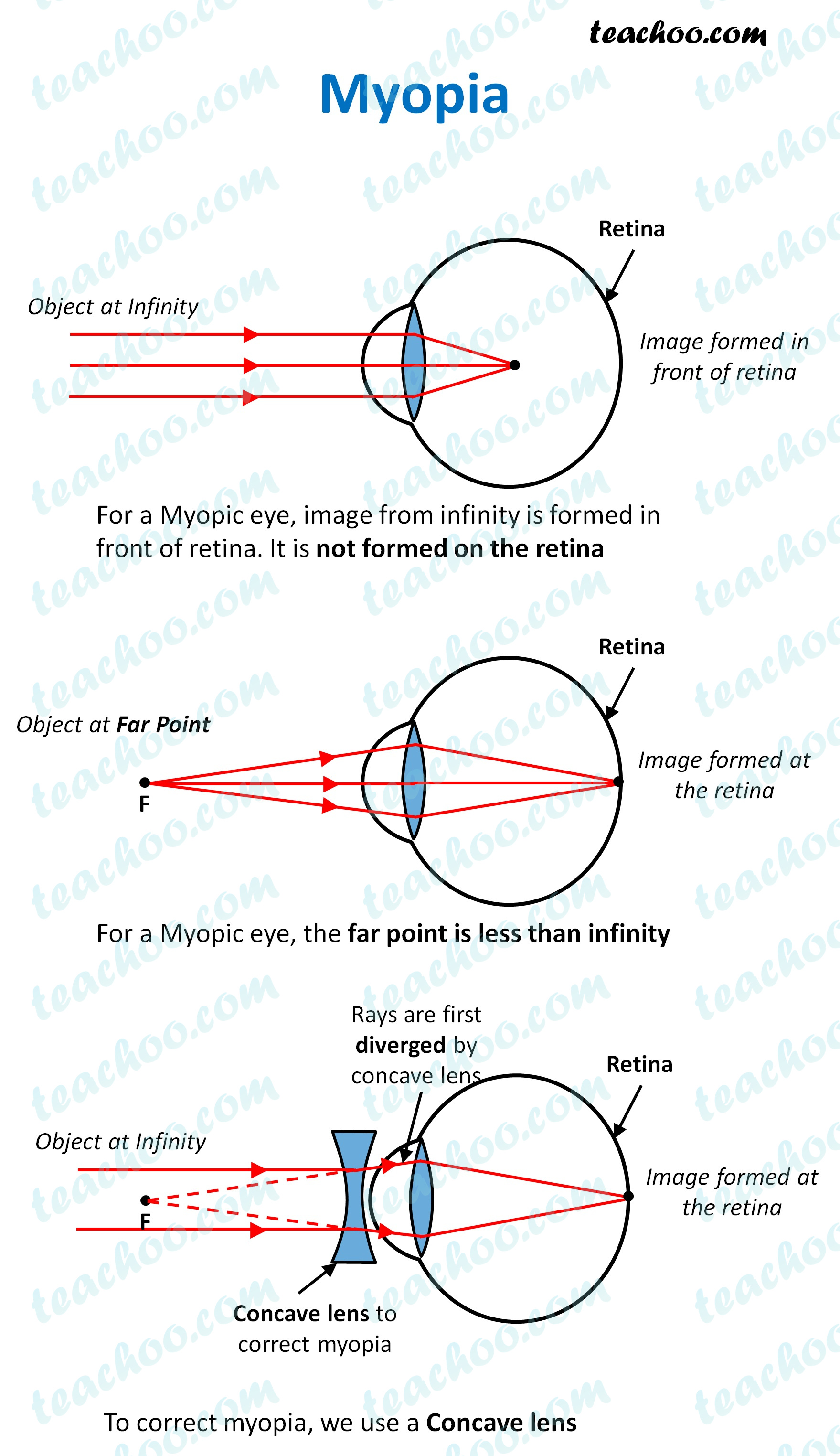 far point of eye