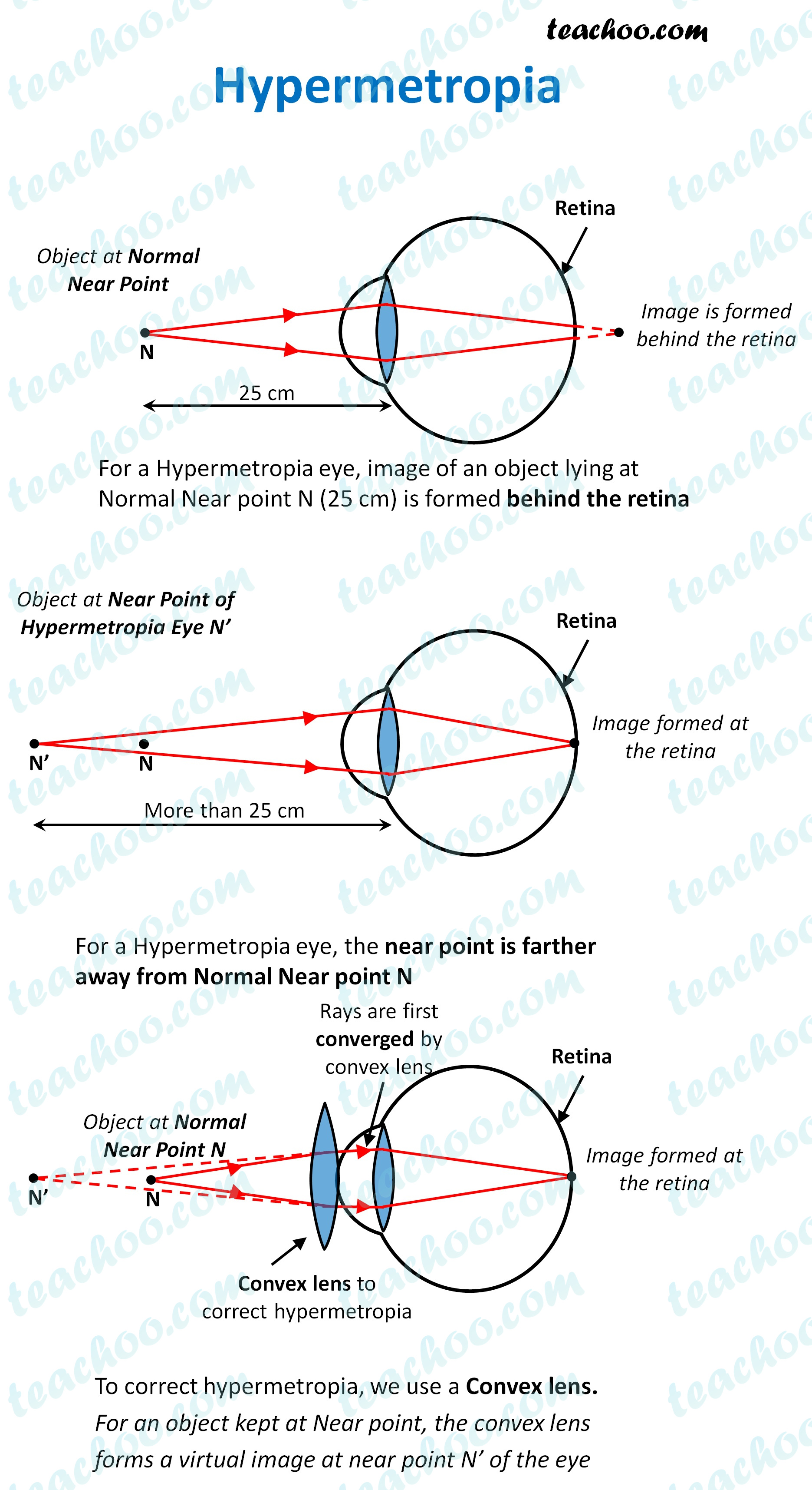 assertion-a-a-hypermetropic-person-prefers-to-eye-class-10-mcq