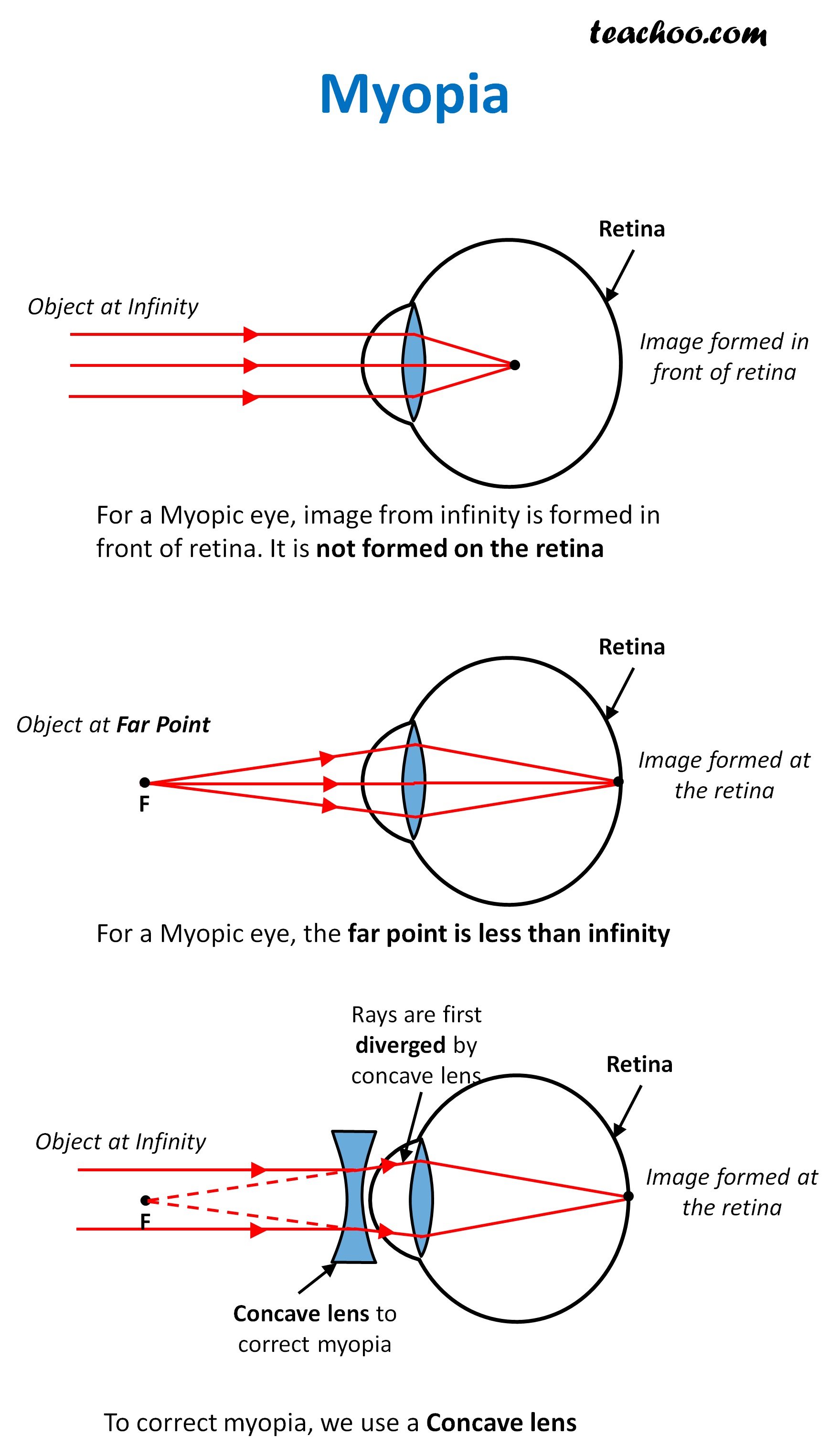 defects-of-vision-myopia-hypermetropia-presbyopia-teachoo