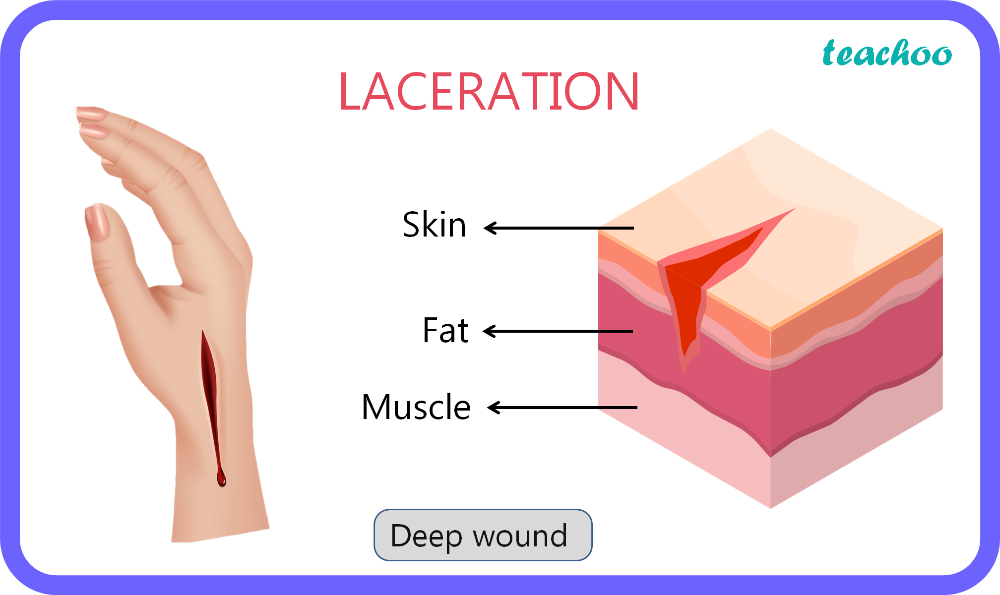 Lacerated Wound Meaning In Malayalam